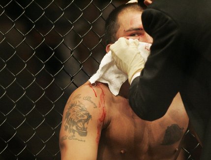 A large gash under James Irvin's right eye is attended to after he was defeated by Anderson Silva in a first round TKO during their UFC bout at the Palms.