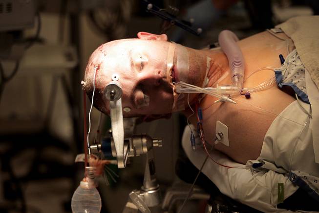 The electrodes that were placed on his brain in the first surgery are seen coming out of Chris Stones' head as he is under anesthetic and being prepared for his second brain surgery, to remove the part of his brain that is causing seizures, at Sunrise Hospital & Medical Center on Tuesday, July 21, 2009.  