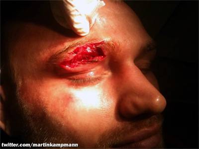 Martin Kampmann shows off a nasty cut over his right eye he sustained while training at Xtreme Couture in February 2010.