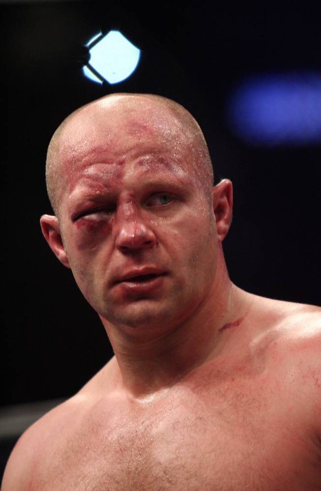 Fedor Emelianenko, of Russia, is seen with the eye that forced a stoppage of his bout against Antonio Silva, of Brazil, during a Strikeforce Heavyweight Grand Prix fight on Saturday, Feb. 12, 2011 at the Izod Center in East Rutherford, N.J. Silva won after the end of the second round when the doctor said Emelianenko could no longer see out of his eye.