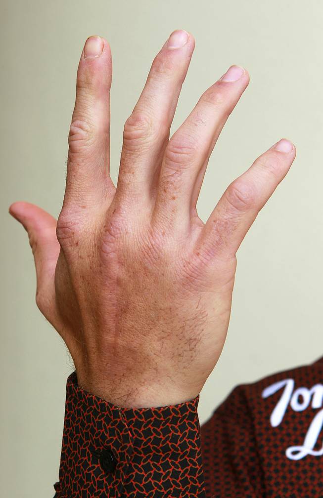 This is the hand that professional bull rider J.W. Harris broke.