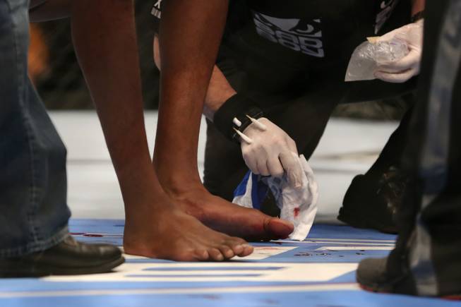 The broken foot of Jon Jones is tended to after Jones beat Chael Sonnen in their UFC 159 light heavyweight title bout in Newark, N.J., Saturday, April 27, 2013. Jones retained his title via first-round TKO.