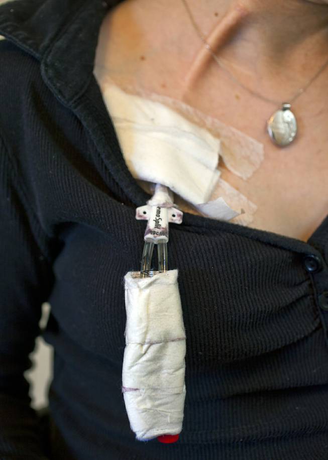A close-up look at Jenny Stiles' perma catheter that is temporarily inserted while she is on dialysis waiting for her second kidney transplant Thursday, Nov. 28, 2013.