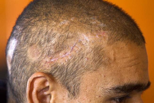 Scars from an assault and robbery are shown on the head of Francisco Diaz in Mexicali, Mexico Sunday, Jan. 26, 2014. Diaz was born in Mexico but grew up in Las Vegas with a green card.