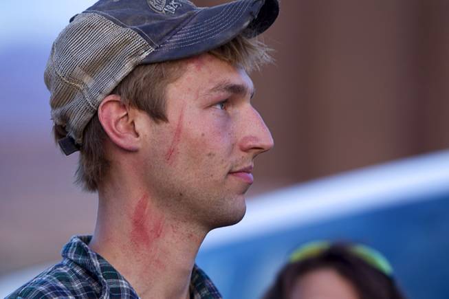 The face of Spencer Shillig of St. George, Utah, shows injuries he says he sustained while being detained by Bureau of Land Management officers in the Lake Mead National Recreation Area near Overton Thursday, April 10, 2014.