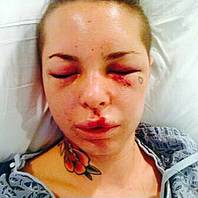 Christy Mack says she suffered severe injuries in a domestic violence dispute involving ex-boyfriend Jon Koppenhaver.