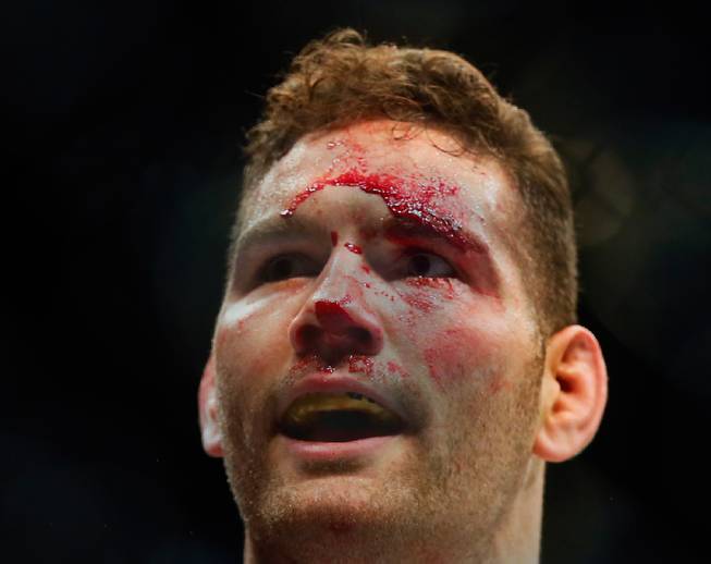 UFC middleweight champion Chris Weidman is bloodied but victorious over contender Vitor Belfort following their UFC 187 fight at the MGM Grand Garden Arena on Friday, May 22, 2015.