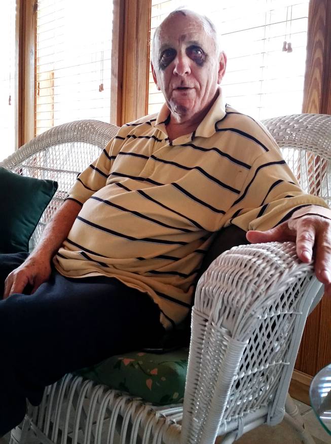 A badly bruised Mayor Larry Barton sits in his home Aug. 14 in Talladega, Ala., discussing what he says was his recent beating by another man armed with a baseball bat.