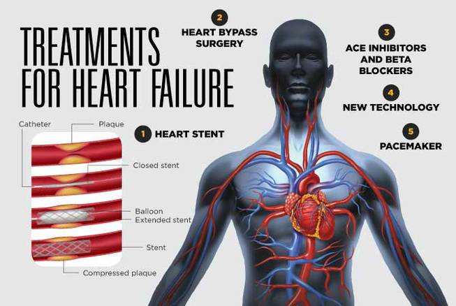 HCA Heart Failure 