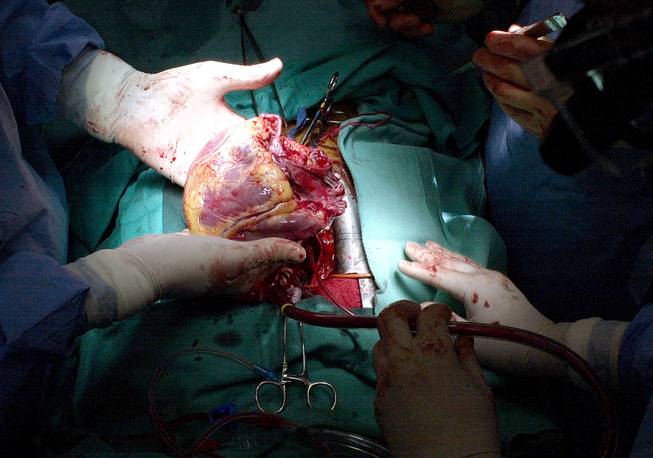 A doctor holds in his hands a diseased  heart which has just been removed from a patient during a heart transplant operation at the Cleveland Clinic in Cleveland. 