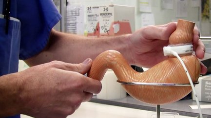 Gastric Band