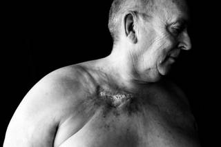 Harold Abramowski, seen in his Overton home August 10, 2010, developed an open wound after a chemotherapy port on his chest leaked, causing the drugs to seep into his flesh during cancer treatment at MountainView Hospital in February 2009.