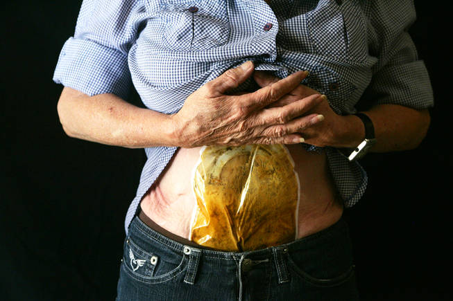 Georganne Mumm holds onto the ostomy bag she wears all the time  in her home Wednesday, September 8, 2010. During surgery Sept. 4, 2007 to remove a cancerous kidney, Dr. Victor Grigoriev cut out part of Georganne Mumm's pancreas and clamped a vein, strangling the blood supply to her spleen. Both had to be removed in a follow-up surgery. Georganne Mumm now lives in constant pain, wears an ostomy bag and rarely leaves her home in Bullhead City, Arizona.