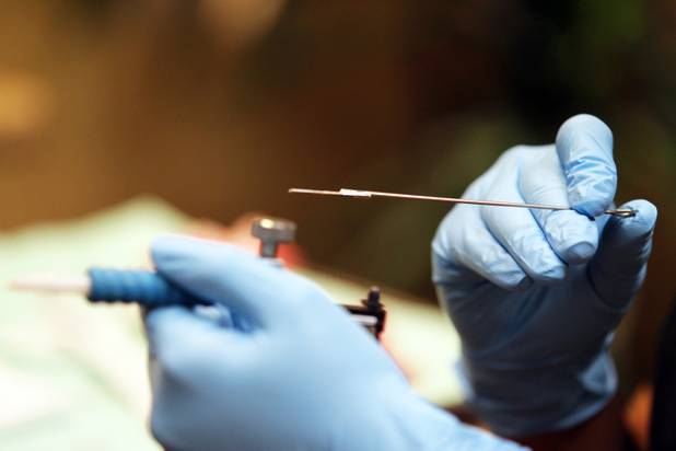 Technician Magdelyn Vasquez-Castro removes a tattoo from the stomach of ...