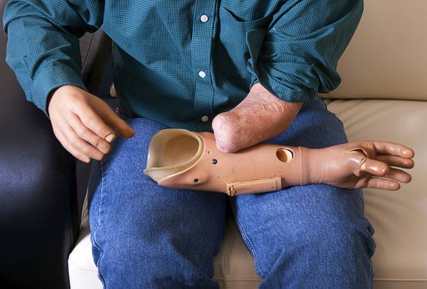 Las Vegas resident Scott Martin, who lost his hands and feet due to the flesh-eating disease, demonstrates how he attaches his prosthetic hands during an interview at his home Wednesday, Dec. 12, 2012. He wrote a passage for "Chicken Soup for the Soul: The Power of Positive" and is working on a memoir.