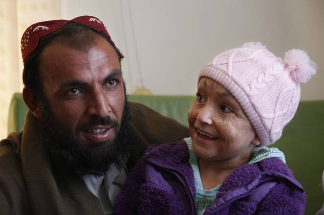 Six-year-old Arefa sits with her father, Sarwan Khan, in Kabul, Afghanistan, on Dec. 8, 2012, after she returned from the United States, where she received treatment for burns on her face and head suffered in a fire in the family's tent.