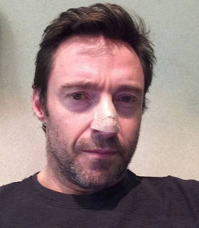 This undated but recent selfie posted on Instagram by Hugh Jackman shows "The Wolverine" star with his bandaged nose. The 45-year-old Oscar-nominated Jackman said he had a basal cell carcinoma, a common form of skin cancer that is rarely fatal. 