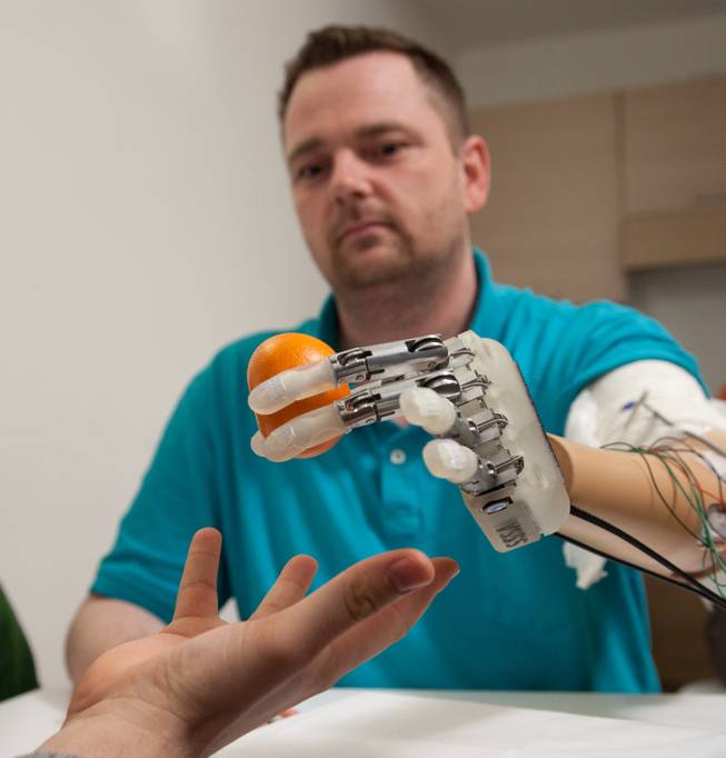 This March 2013 handout photo provided by Science Translational Medicine shows amputee Dennis Aabo Sørensen holding an orange while wearing sensory feedback enabled prosthesis in Rome.