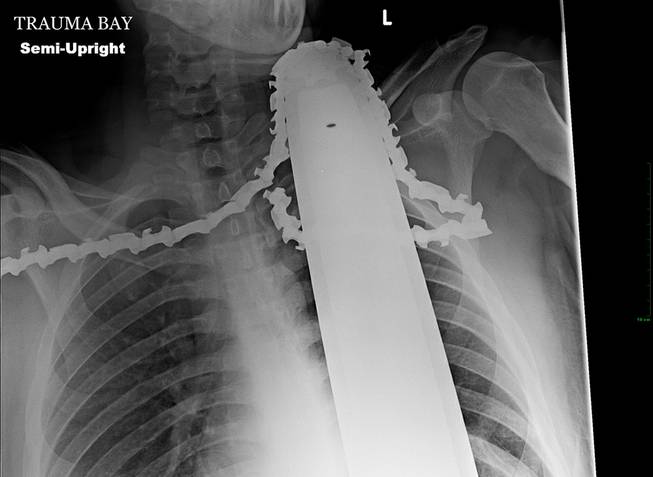 This Monday, March 31, 2014 photo shows an X-ray of a chain saw blade embedded in the neck of a patient, at Allegheny General Hospital, in Pittsburgh. 
