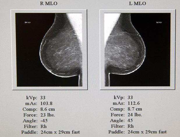 A mammography scan is displayed on a monitor in the Nevada Health Centers Mammovan Wednesday, April 19, 2017.