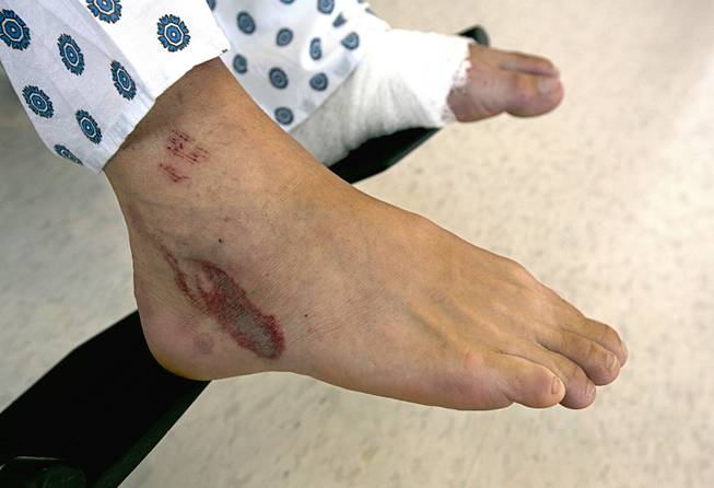 Some of the wounds Mathias Steinhuber received from being struck by a lighting bolt are seen on his right foot as he discusses the near-fatal event, Thursday, Aug. 24, 2017, in Sacramento, Calif. His left foot, where the lightning exited his body, is wrapped. Steinhuber, of Innsbruck, Austria, had been hiking the Pacific Crest Trail near Donner Summit Tuesday when he stopped to take a photo and was hit by the lighting. He was taken by helicopter to the the Tahoe Forest Hospital in Truckee, before being flown to the University of California, Davis Hospital Burn Center where he is listed in fair condition. 